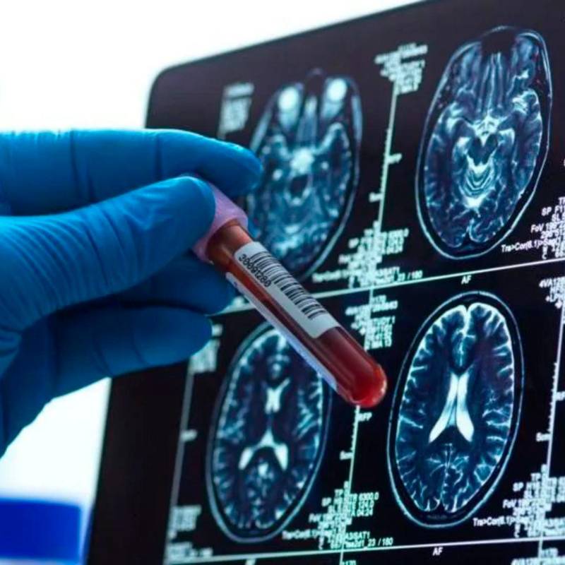 Según estimaciones, en el mundo hay alrededor de 57 millones de pacientes con Alzheimer. Los tratamientos todavía son materia de estudio. FOTO: Getty