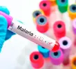 La malaria es una enfermedad tropical transmitida por un mosquito. FOTO SSTOCK