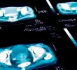 La prueba de antígeno prostático específico (PSA) es una herramienta clave para la detección temprana del cáncer de próstata. FOTO Getty