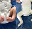 A la izquierda, un recién nacido con pie equinovaro; a la derecha, un niño con la férula utilizada en el tratamiento Ponseti. FOTOS cortesía Clínica Foscal