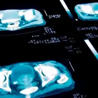 La prueba de antígeno prostático específico (PSA) es una herramienta clave para la detección temprana del cáncer de próstata. FOTO Getty