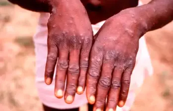 Esta enfermedad se caracteriza por la aparición de lesiones cutáneas con apariencia de granos o ampollas en cualquier parte del cuerpo, incluida la zona genital. FOTO: GETTY Esta enfermedad se caracteriza por la aparición de lesiones cutáneas con apariencia de granos o ampollas en cualquier parte del cuerpo, incluida la zona genital. FOTO: GETTY