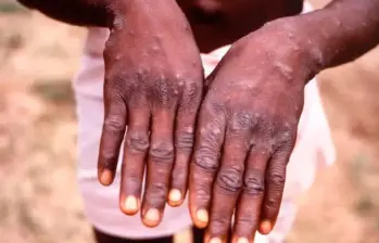 Esta enfermedad se caracteriza por la aparición de lesiones cutáneas con apariencia de granos o ampollas en cualquier parte del cuerpo, incluida la zona genital. FOTO: GETTY Esta enfermedad se caracteriza por la aparición de lesiones cutáneas con apariencia de granos o ampollas en cualquier parte del cuerpo, incluida la zona genital. FOTO: GETTY