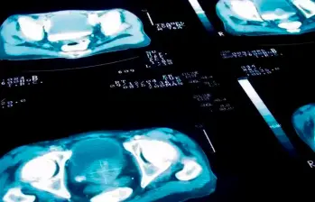 La prueba de antígeno prostático específico (PSA) es una herramienta clave para la detección temprana del cáncer de próstata. FOTO Getty
