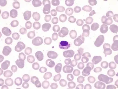 Bacteria Capnocytophaga canimorsus. FOTO: Neus Amer, Irene Vázquez, Hospital Universitario Son Llàtzer, Palma de Mallorca, España. Grupo Español de Citología Hematológica.