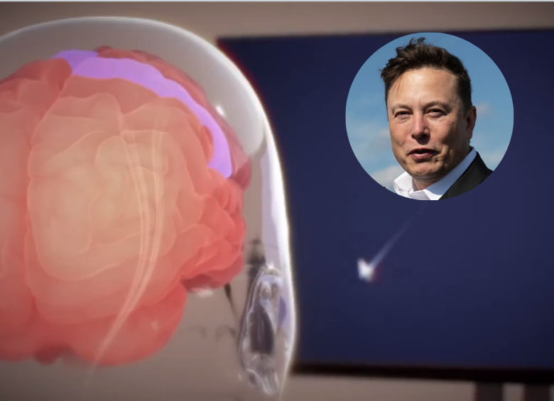 Neuralink de Elon Musk implantó por primera vez su chip cerebral en