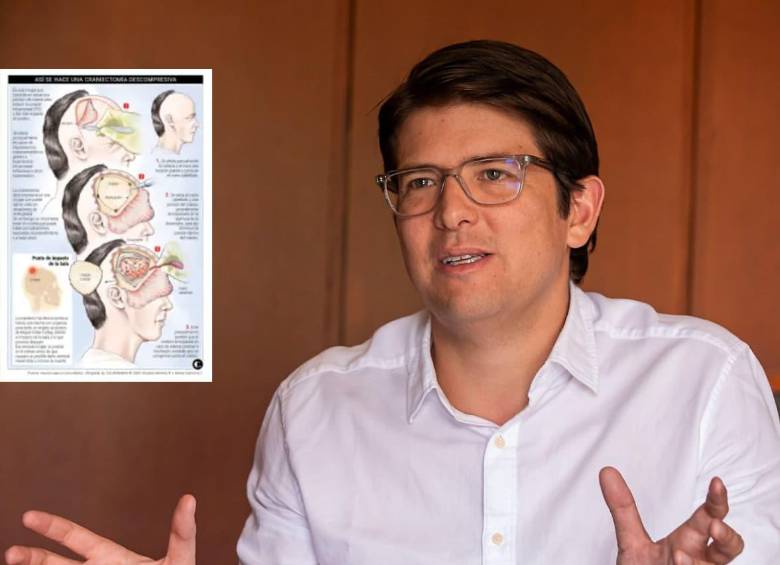 Así le habrían realizado la craniectomía descompresiva en Miguel Uribe Turbay. FOTO: EL COLOMBIANO