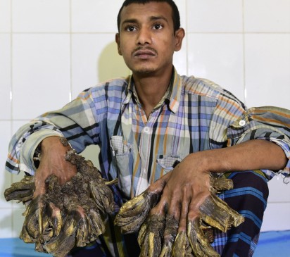 Abul Bajandar tiene 26 años y sufre de una epidermodisplasia verruciforme, una enfermedad no contagiosa de la que apenas se conocen unos pocos casos en todo el mundo. FOTO AFP