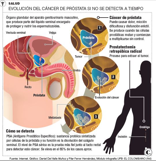 Infografía sobre el cáncer de próstata. INFOGRAFÍA EL COLOMBIANO