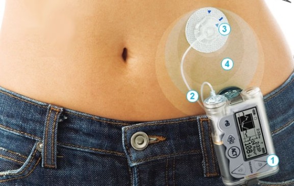 El dispositivo es discreto. Se puede usar en distintas partes del cuerpo para monitorear la glucosa y activar el suministro de insulina según necesidad. FOTO cortesía medtronic