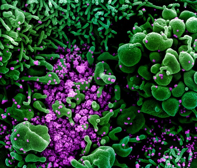 Los puntos morados en la imagen son las partículas víricas. En verde están las células en apoptosis, es decir, ‘suicidándose’ ante la infección del coronavirus SARS-CoV-2. El color es artificial. FOTO Instituto Nacional de Alergias y Enfermedades Infecciosas (NIAID, en inglés) de Estados Unidos . .