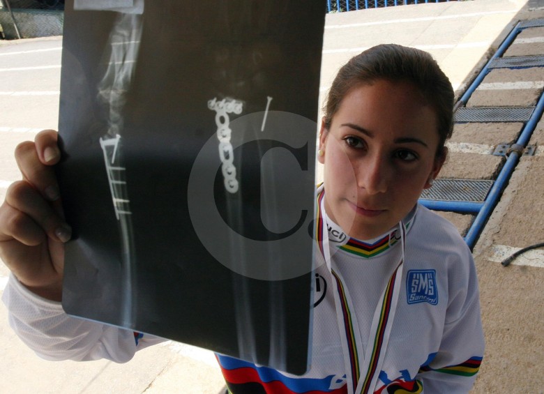 Mariana Pajón mostraba una de sus lesiones en el año 2008, cuando aún era una niña, cicatrices que le ha dejado el alto rendimiento. FOTO ARCHIVO EL COLOMBIANO