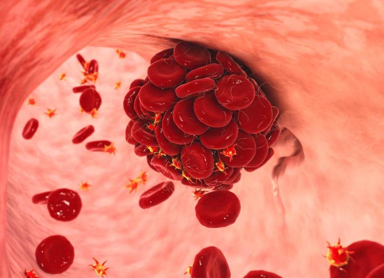 Los coágulos de sangre son masas que se forman cuando las plaquetas, proteínas y células de la sangre se pegan entre sí. FOTO: SSTOCK