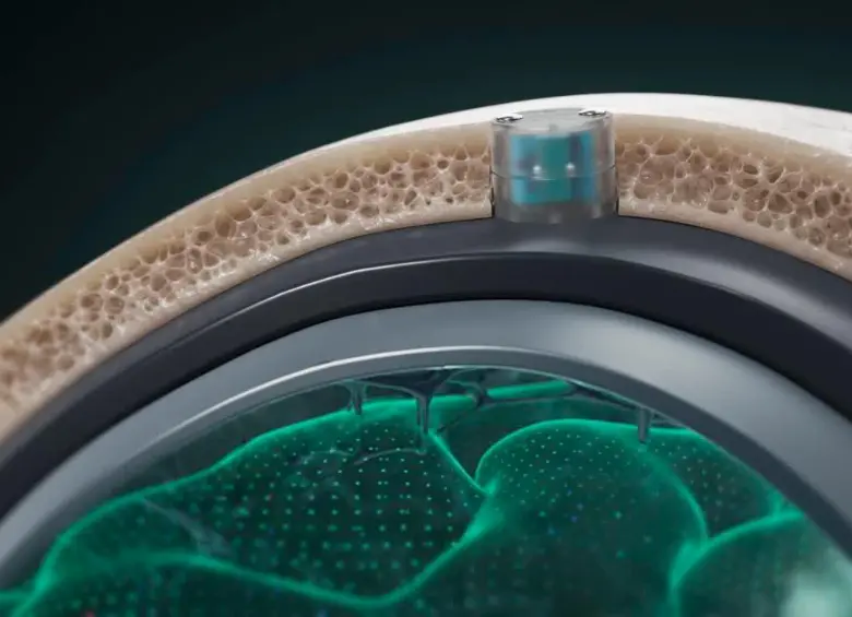 Para implantar el chip es necesario realizar una cirugía ambulatoria de 20 minutos. La ventaja del DOT es que no hace contacto directo con el cerebro. FOTO: Cortesía Motif Neurotech.