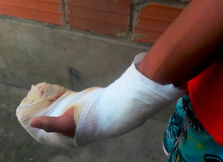 El menor lesionado tuvo que ser intervenido por las quemaduras sufridas con un volador dentro de su vivienda. FOTO: ARCHIVO - MAURICIO PALACIO