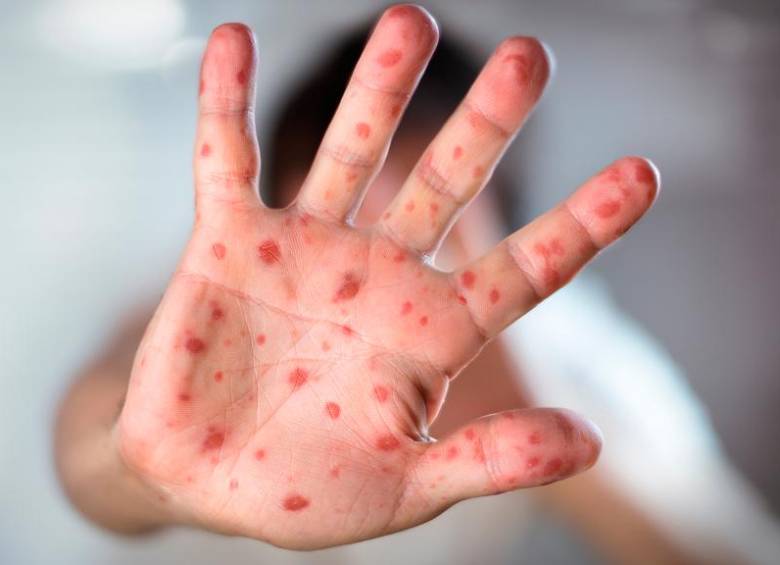 Las erupciones cutáneas aparecen entre 7 y 18 días después de la exposición al virus. FOTO Cortesía MinSalud