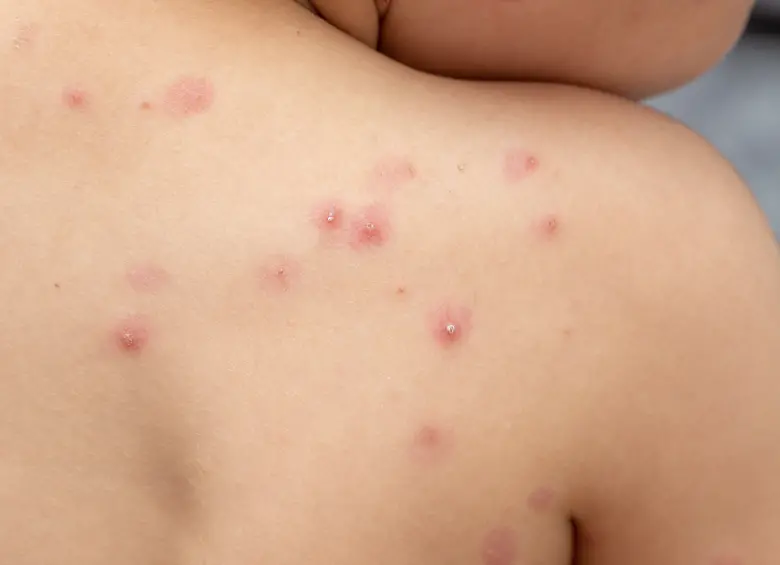 Viruela símica Clado Ib llega a Antioquia: todo lo que debe saber para protegerse