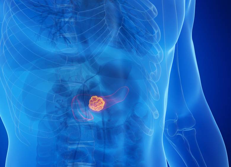 El cáncer de páncreas es uno de los más letales y resistentes a los tratamientos. Nuevas investigaciones apuntan a prolongar la supervivencia de los pacientes tras décadas sin avances significativos. FOTO AFP