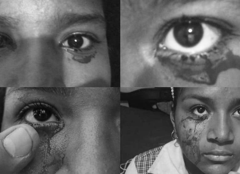 Zharick Ramírez Carillo busca ayuda de un especialista que le pueda detener el sangrado. FOTOS CORTESÍA 