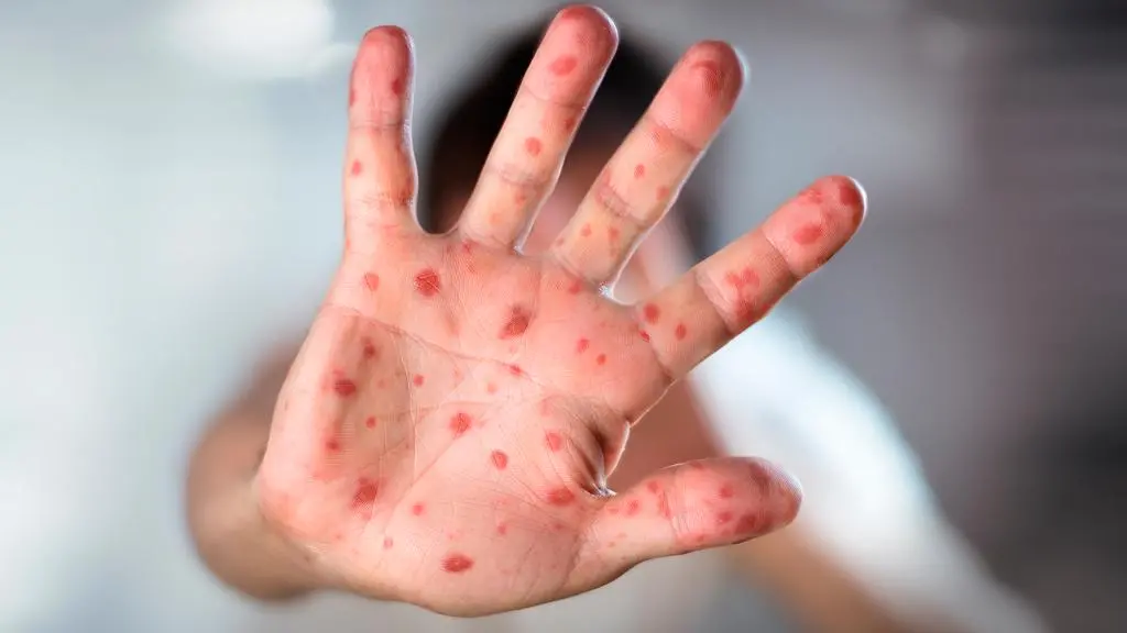 Las erupciones cutáneas aparecen entre 7 y 18 días después de la exposición al virus. FOTO Cortesía MinSalud