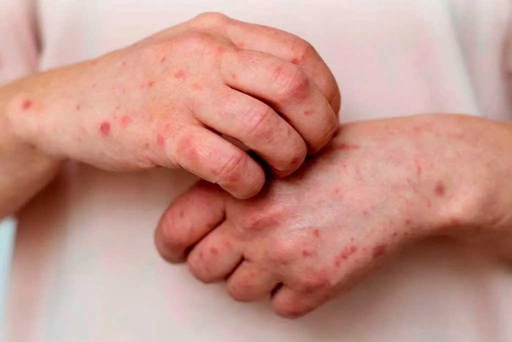 Casos de mpox variante clado Ib en Colombia. Foto: cortesía Prensa Latina