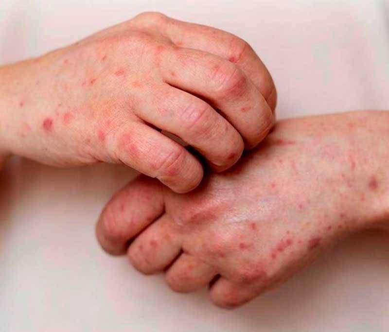 Casos de mpox variante clado Ib en Colombia. Foto: cortesía Prensa Latina