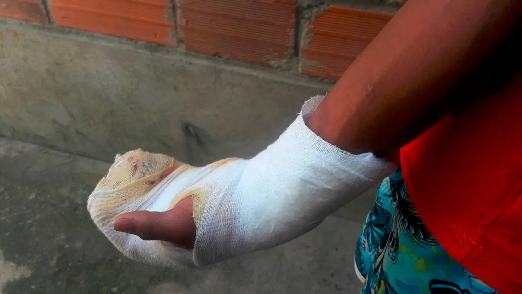 El menor lesionado tuvo que ser intervenido por las quemaduras sufridas con un volador dentro de su vivienda. FOTO: ARCHIVO - MAURICIO PALACIO