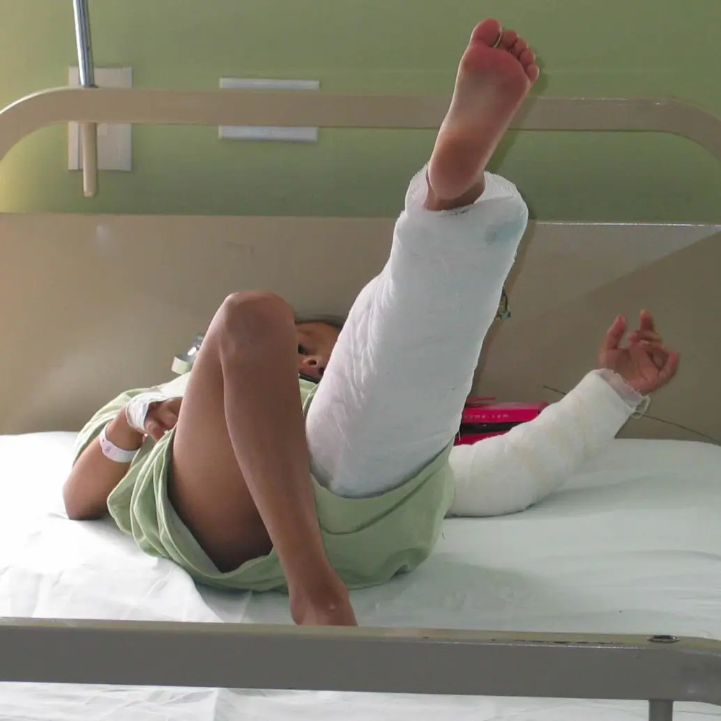 Imagen de referencia de un menor de edad quemado con pólvora. Foto: EL COLOMBIANO