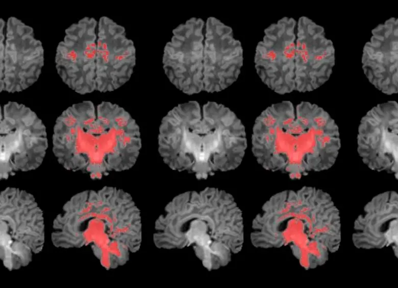 Es el primer estudio que mide con resonancia magnética la mielinización cerebral de los recién nacidos. FOTO Pujol et al., 2025 | ISGlobal