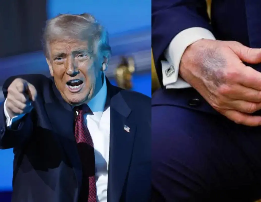 Donald Trump, de 79 años, respondió a las dudas sobre su salud tras la difusión de imágenes que mostraban moretones en su mano derecha. FOTO: Getty Images, redes sociales. 