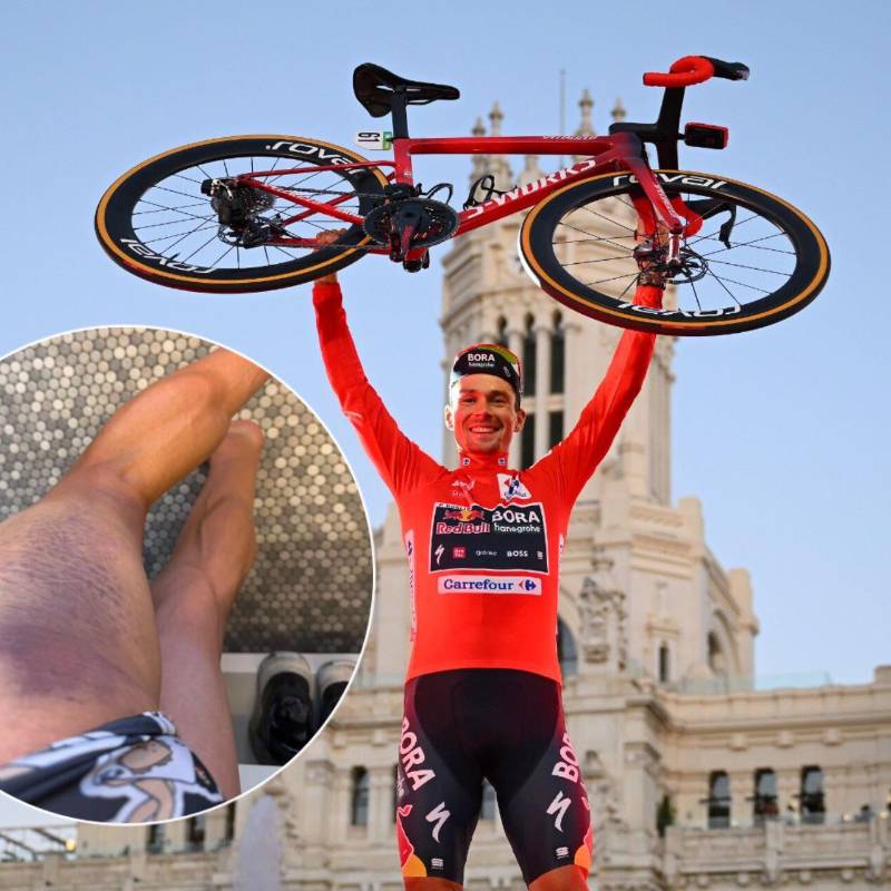 El ciclista esloveno cuatro veces ganador de La Vuelta a España, Primoz Roglic, mostró cómo quedó su pierna tras ser atropellado en Austria. Fotos: Getty Images y primozroglic