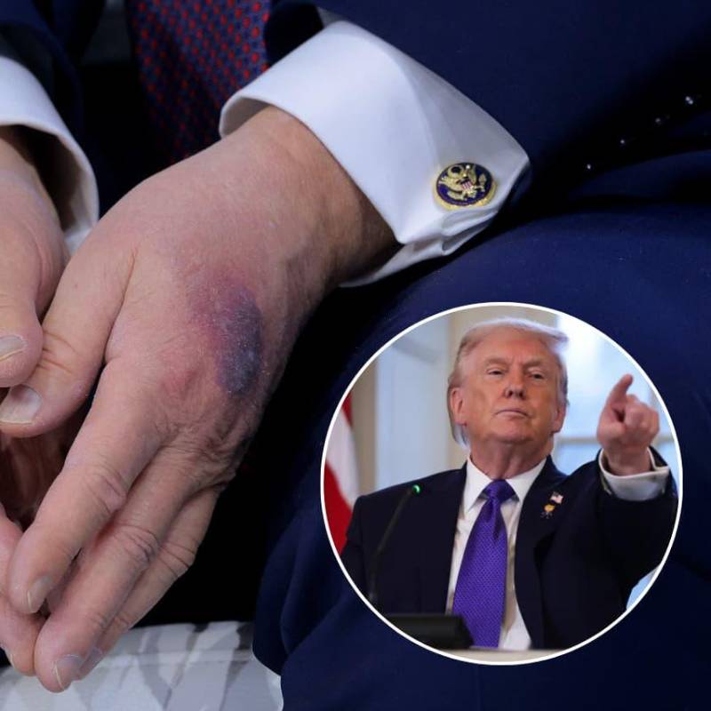 Los hematomas en la mano de Donald Trump que lo ponen bajo la lupa en redes sociales. Fotos: Getty Images 
