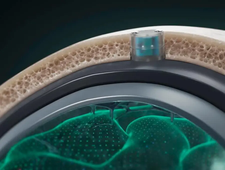 Para implantar el chip es necesario realizar una cirugía ambulatoria de 20 minutos. La ventaja del DOT es que no hace contacto directo con el cerebro. FOTO: <span class="mln_uppercase_mln">Cortesía Motif Neurotech.</span>