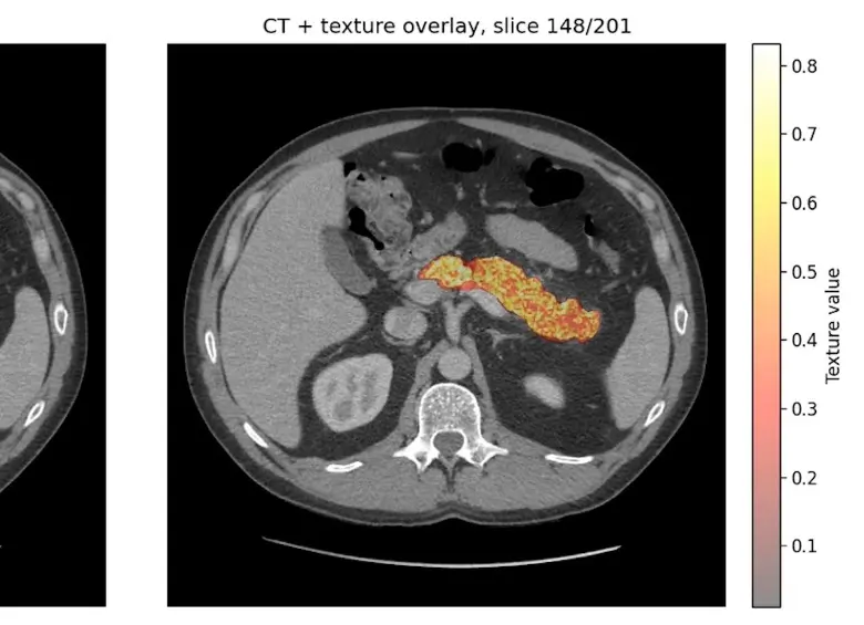 El modelo REDMOD identifica señales imperceptibles de cáncer de páncreas en tomografías abdominales de rutina antes de que los tumores sean visibles. FOTO cortesía Mayo Clinic