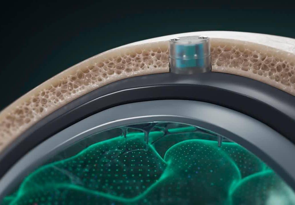 Para implantar el chip es necesario realizar una cirugía ambulatoria de 20 minutos. La ventaja del DOT es que no hace contacto directo con el cerebro. FOTO: <span class="mln_uppercase_mln">Cortesía Motif Neurotech.</span>