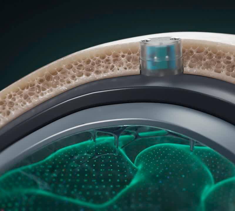 Para implantar el chip es necesario realizar una cirugía ambulatoria de 20 minutos. La ventaja del DOT es que no hace contacto directo con el cerebro. FOTO: Cortesía Motif Neurotech.