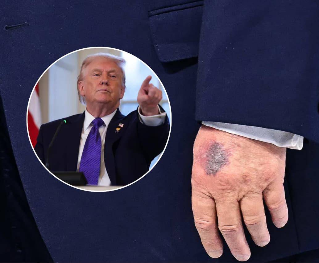 Los hematomas en la mano de Donald Trump que lo ponen bajo la lupa en redes sociales<i>Fotos: Getty Images / redes sociales</i>