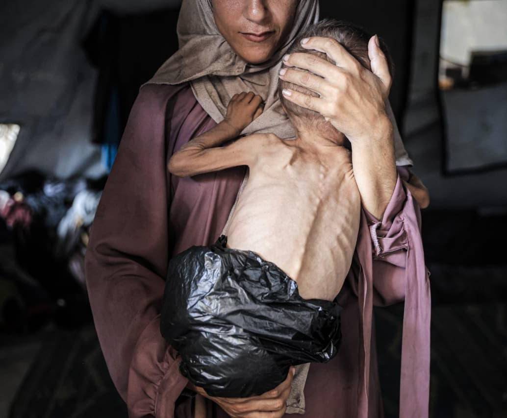 Muhammad Zakariya Ayyoub al-Matouq, un niño de un año y medio en la ciudad de Gaza, enfrenta una desnutrición que pone en peligro su vida a medida que la situación humanitaria empeora debido a los continuos ataques y bloqueos israelíes, el 21 de julio de 2025. Tras haber bajado de 9 a 6 kilos, lucha por sobrevivir en una tienda de campaña en la ciudad de Gaza, donde escasean leche, alimentos y otros artículos de primera necesidad. Foto: Ahmed Jihad Ibrahim Al-arini/Anadolu via Getty Images