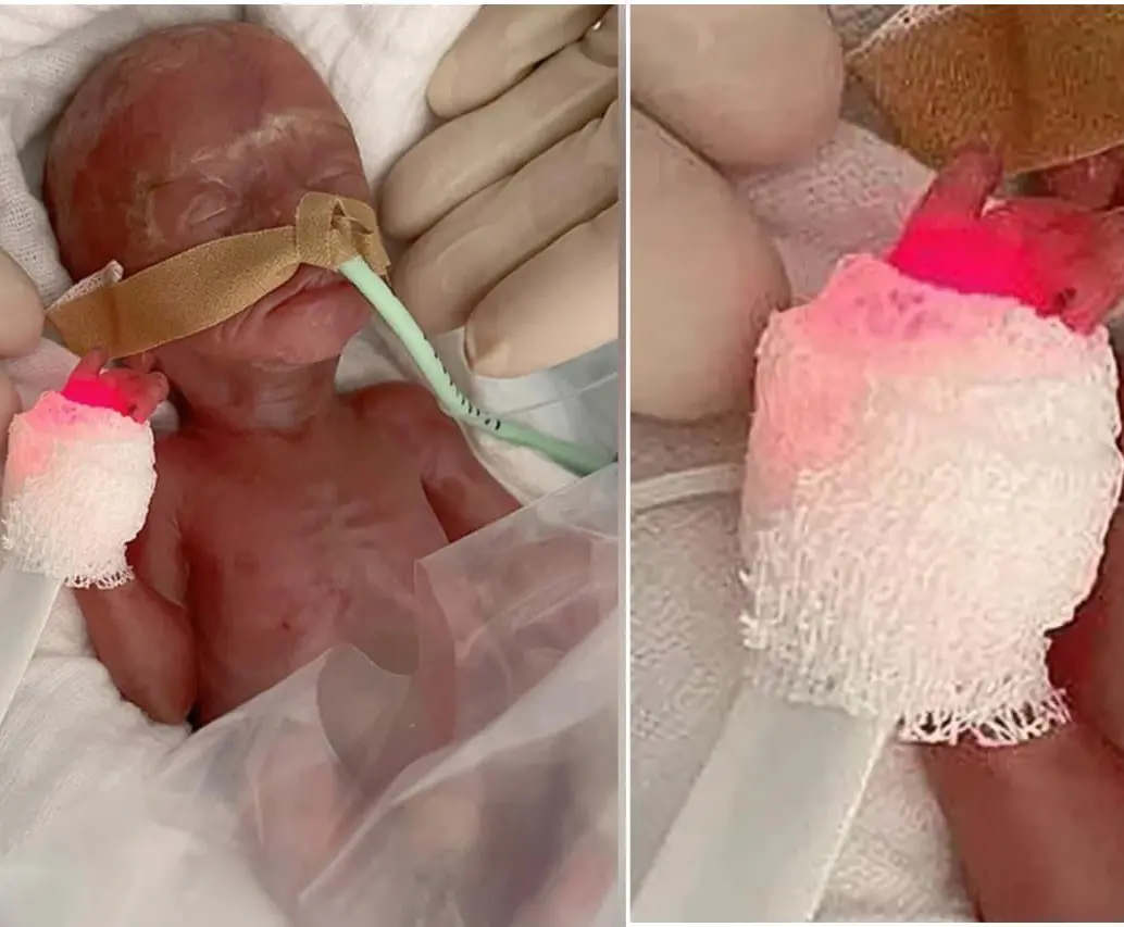 Una bebé en Alemania nació 16 semanas antes de la fecha prevista y con un peso de 300 gramos. FOTOS: Hospital Universitario de Magdeburgo