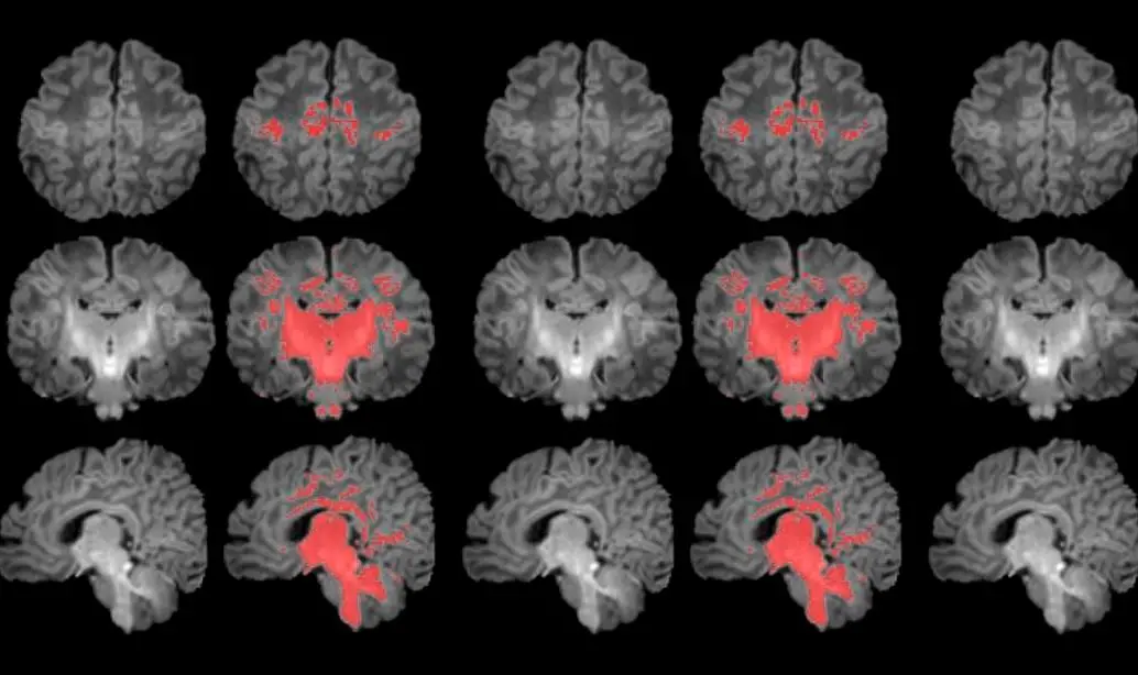 Es el primer estudio que mide con resonancia magnética la mielinización cerebral de los recién nacidos. FOTO Pujol et al., 2025 | ISGlobal