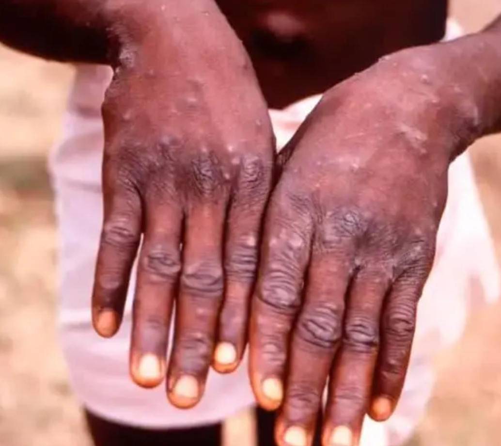 Las llagas aparecen entre uno o cinco días después de los primeros síntomas. FOTO GETTY.