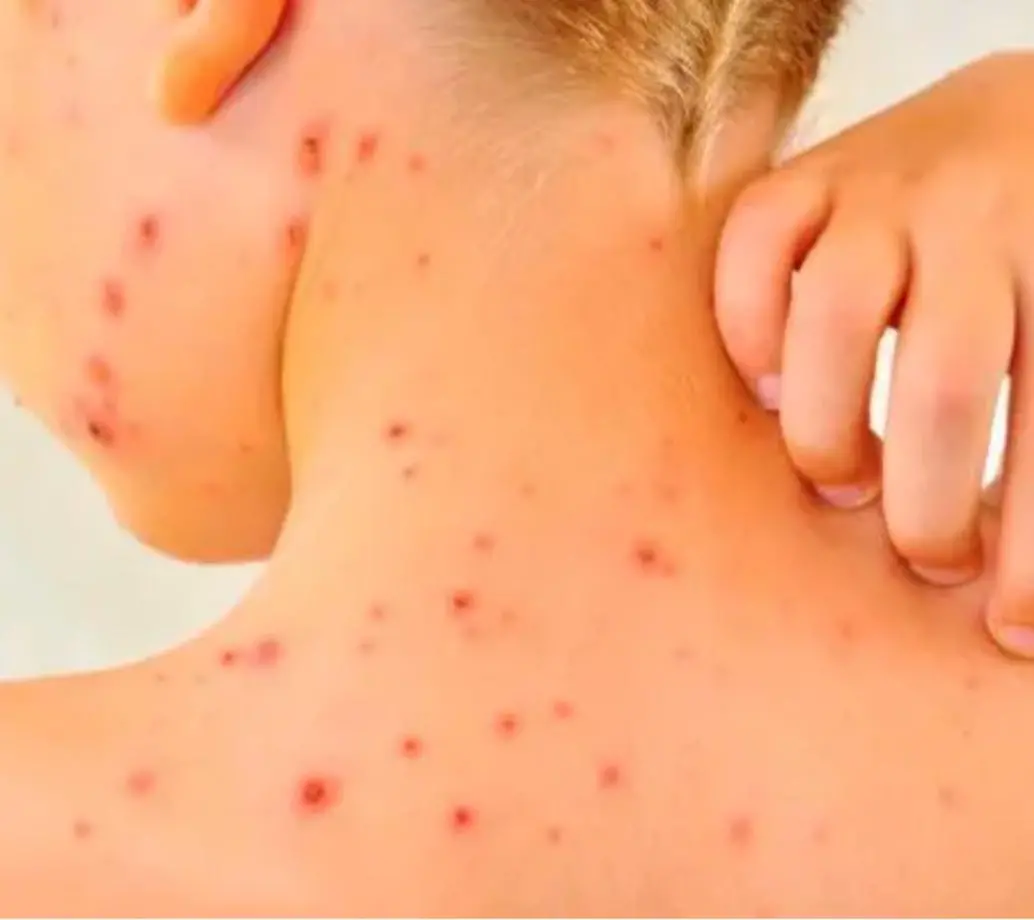 El equipo epidemiológico de la Secretaría de Salud de Bello mantendrá por lo menos tres semanas más la vigilancia hasta que no haya un solo caso de varicela. IMAGEN ILUSTRATIVA.