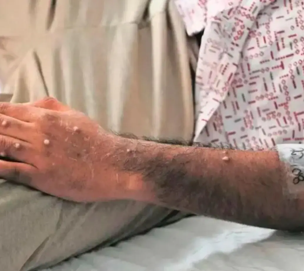 Las llagas aparecen entre uno y cinco días después de los primeros síntomas. FOTO CORTESÍA OMS.