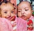 El efecto mágico de poder sonreír: termina misión para operar a 100 niños con labios y encía fisurada en Medellín