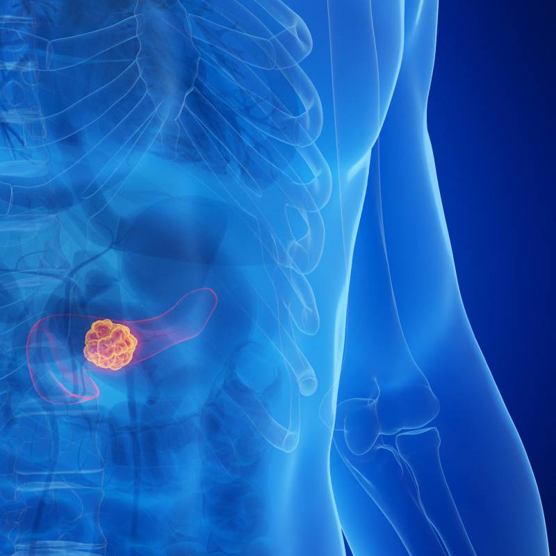 El cáncer de páncreas es uno de los más letales y resistentes a los tratamientos. Nuevas investigaciones apuntan a prolongar la supervivencia de los pacientes tras décadas sin avances significativos. FOTO AFP