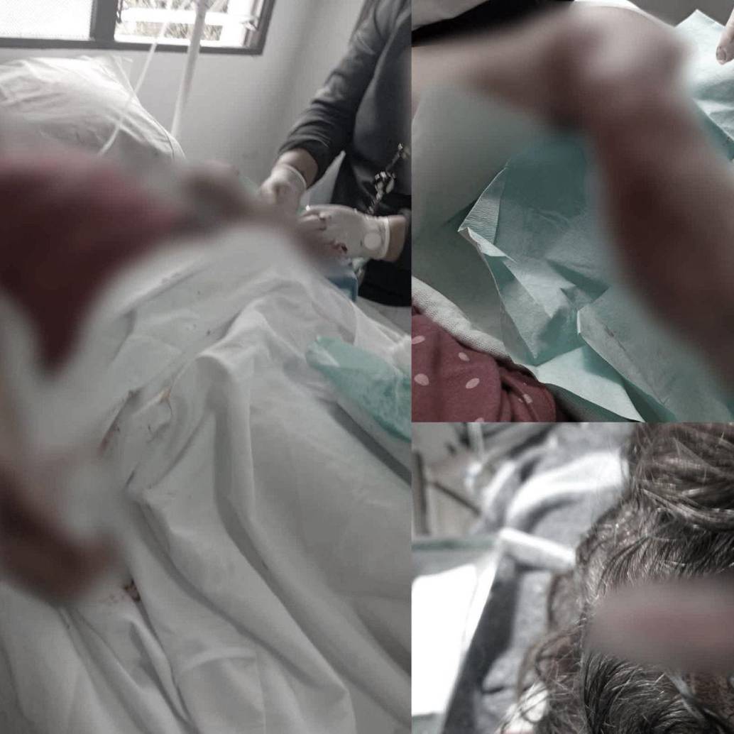 Doña Orfilia sufrió lesiones en el brazo izquierdo, con amputación de un dedo; así como mordeduras en la cabeza y en la cara. FOTOS: CORTESÍA