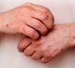 Casos de mpox variante clado Ib en Colombia. Foto: cortesía Prensa Latina