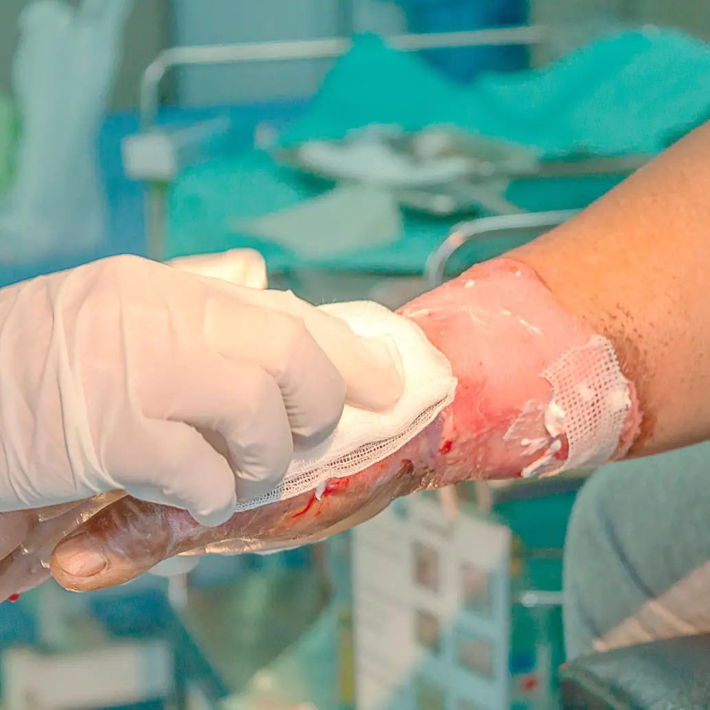 40 personas en Antioquia han sufrido lesiones grado 2 y 3, que implican en muchos casos daños irreversibles. FOTO: GETTY