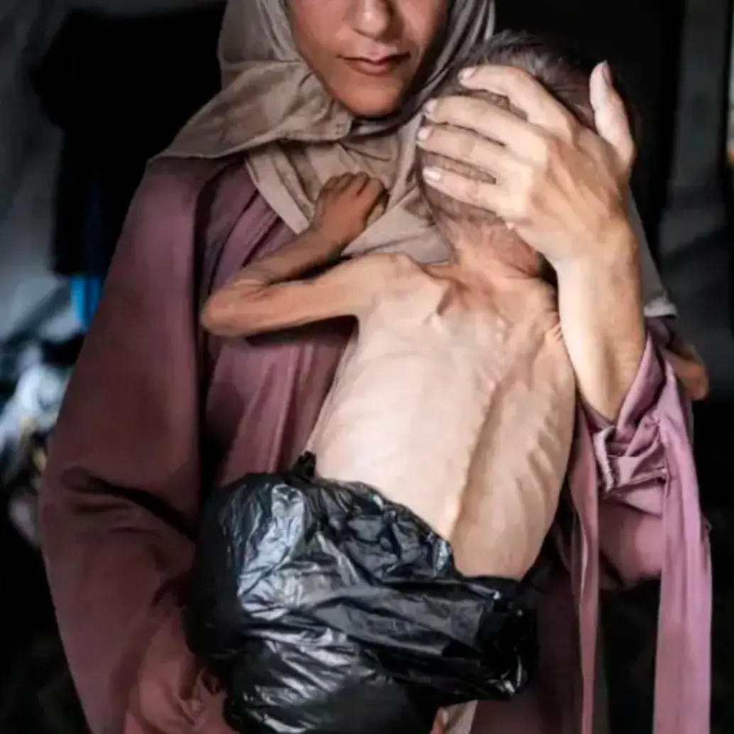 La Organización Mundial de la Salud afirma que 148 personas murieron de desnutrición en Gaza desde enero de 2025. FOTO: Ahmed al-Arini, Getty