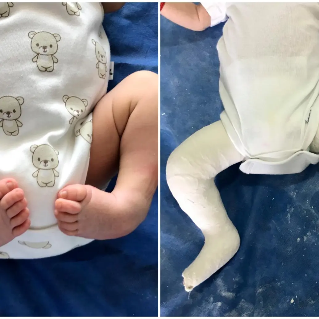 A la izquierda, un recién nacido con pie equinovaro; a la derecha, un niño con la férula utilizada en el tratamiento Ponseti. FOTOS cortesía Clínica Foscal